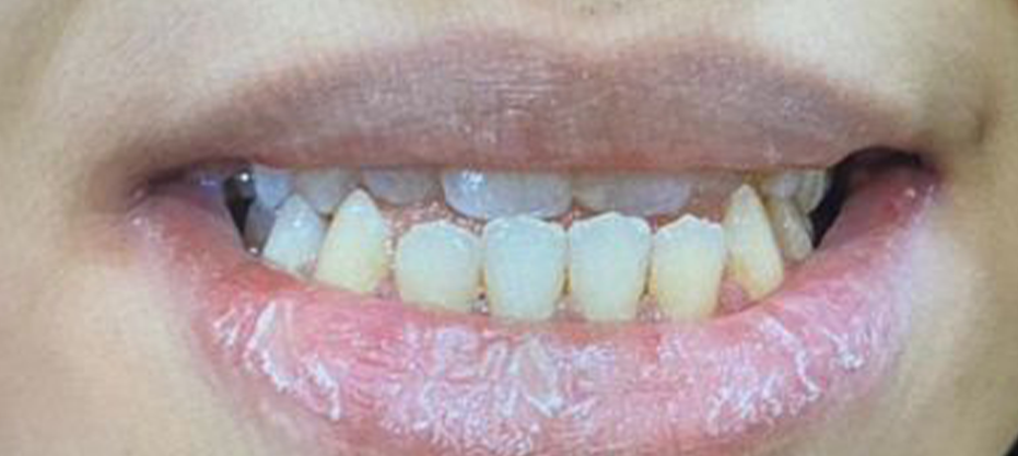 After dental result