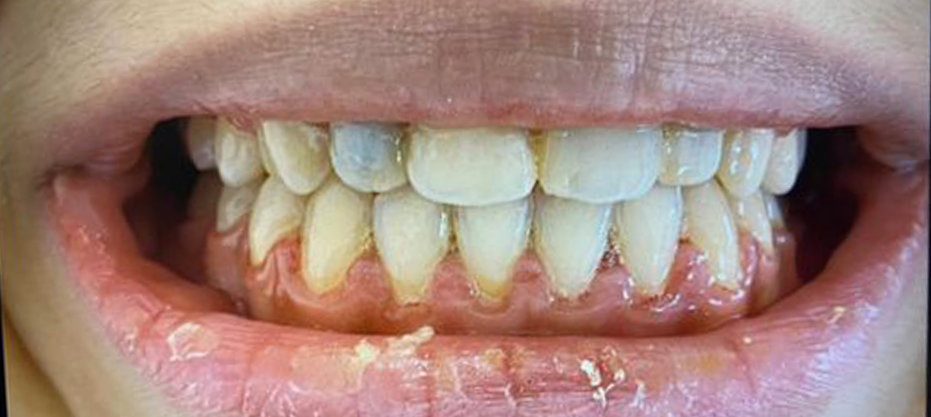 Before dental result