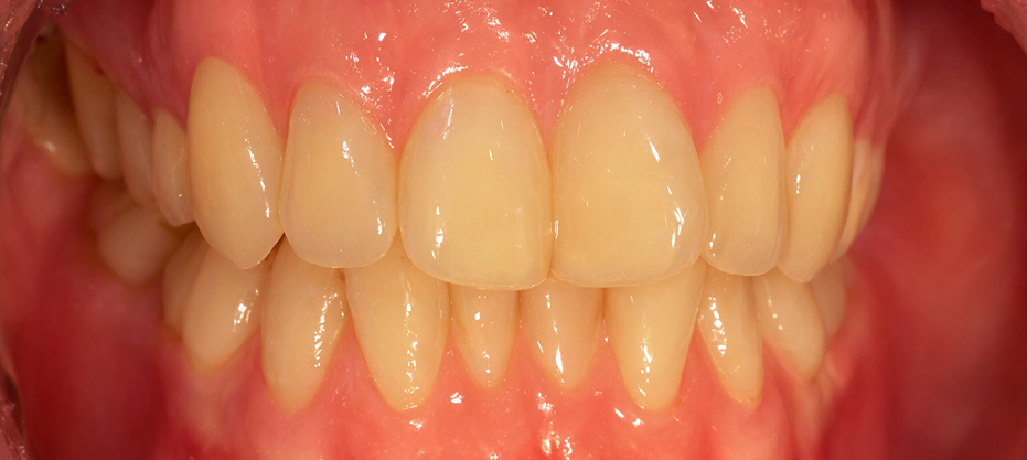 After dental result