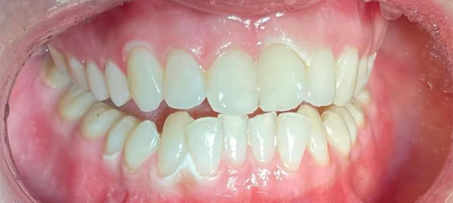 Before dental result
