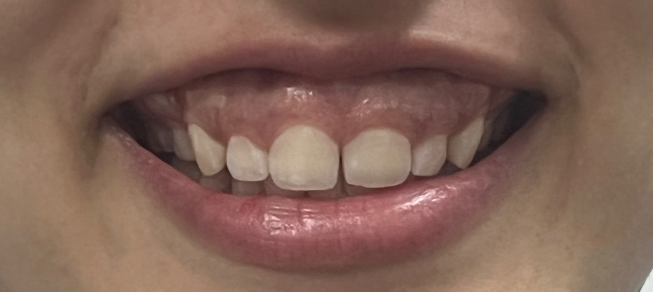 After dental result