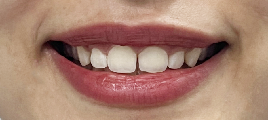 Before dental result