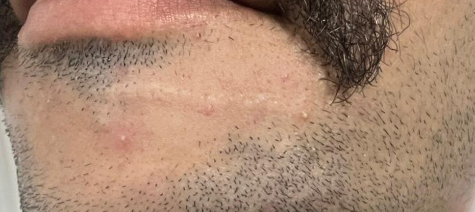 Before dermatology result
