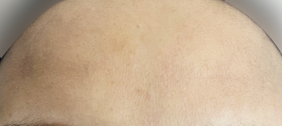 Before dermatology result
