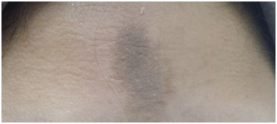 After dermatology result