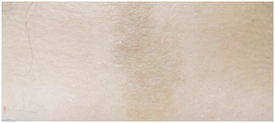 Before dermatology result