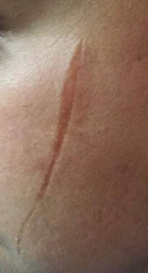 After dermatology result