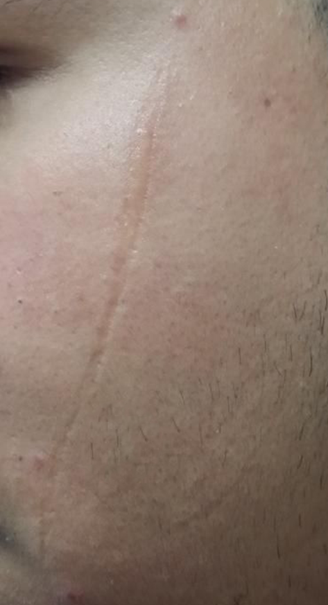 Before dermatology result