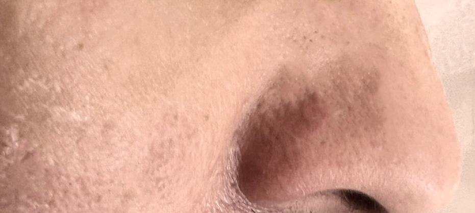 After dermatology result
