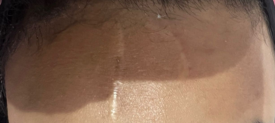 After dermatology result