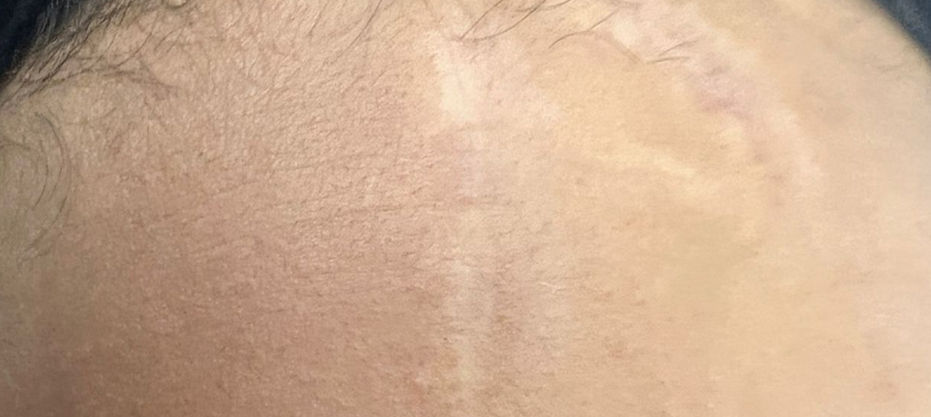 Before dermatology result