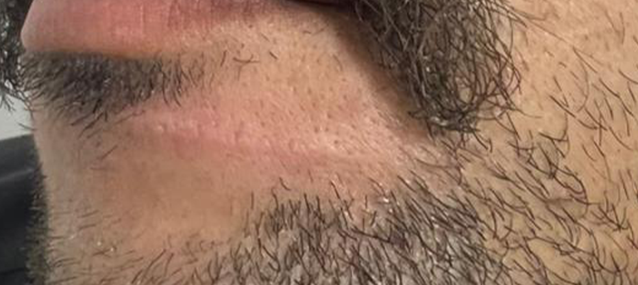 After dermatology result